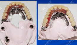 假牙制作方法视频,从视频学习精湛工艺